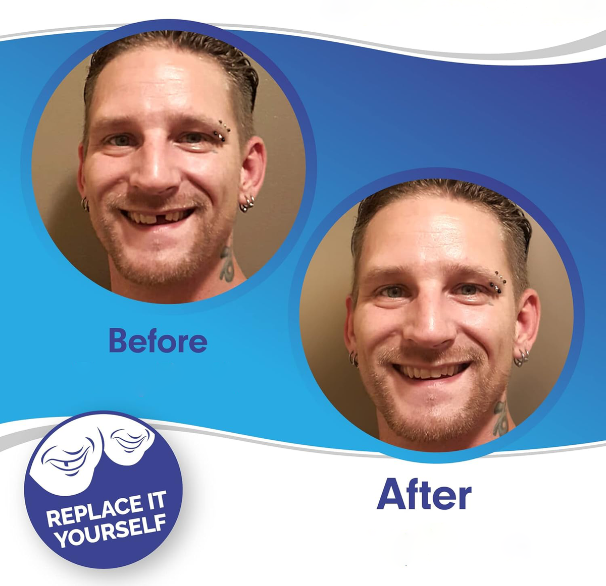 Custom Fit Veneers | Snap-On Solution for Instant Smile Transformation | Comfortable, Durable Design for Flawless Confidence 1